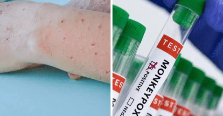 Mpox Virus Poses Significant and Complex Health Risk 1