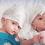 Pakistani Conjoined Twins Successfully Separated in Turkiye