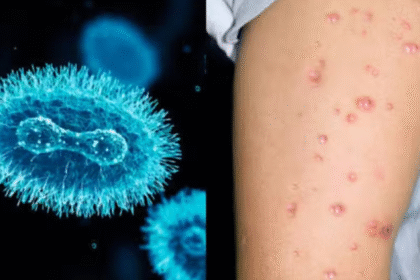 WHO Approves Mpox Diagnostic Test