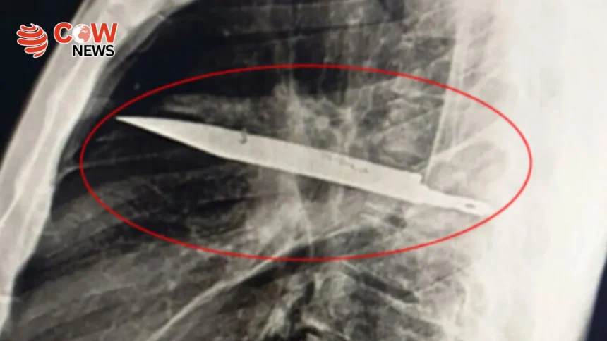 Man Lived 8 Years With Knife Stuck in Chest Doctors Shocked