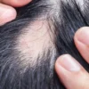 Link Between Weight Loss Medications and Hair Loss Revealed in New Study - The COW News