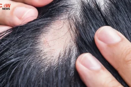 Link Between Weight Loss Medications and Hair Loss Revealed in New Study - The COW News