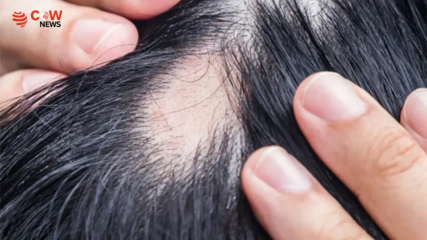 Link Between Weight Loss Medications and Hair Loss Revealed in New Study - The COW News